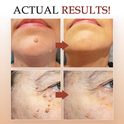 ⭐𝐒𝐎𝐋𝐕𝐈𝐑𝐎𝐍® Tags & Moles Remover